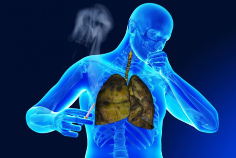 Курение - частая причина патологий дыхательных путей