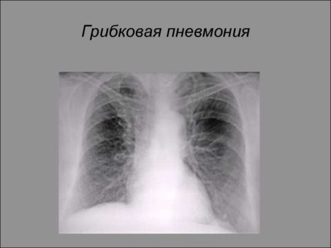Рентген-снимок при грибковой пневмонии