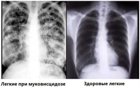 Рентгенологическая картина