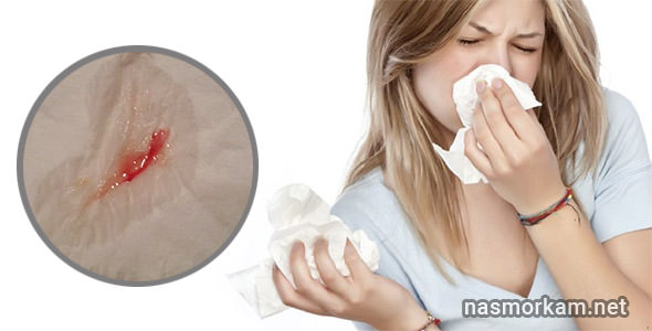 Из носа сгустки крови: причины. почему образуются? методы терапии
