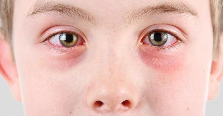 Причины покраснения глаз у ребенка и взрослых при простуде