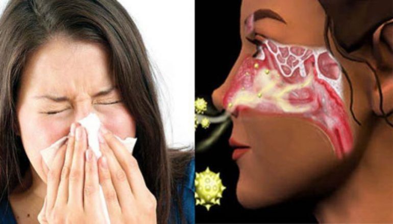 Как отличить аллергический ринит от простудного 