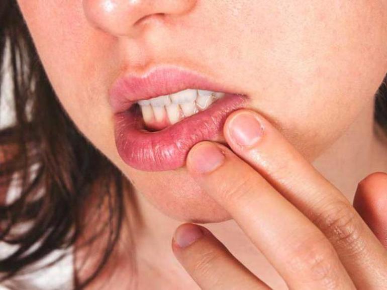 Заразна ли простуда на губе и чем её можно вылечить