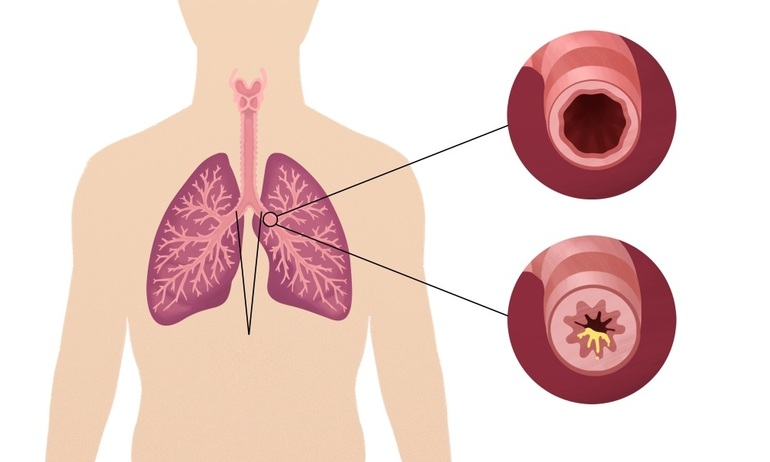 Общие сведения о заболевании дыхательной системы 