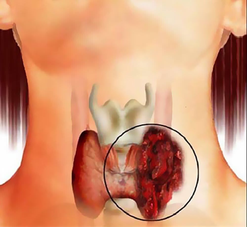 Щитовидная железа – важный орган эндокринной системы