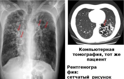 Рентгенологическая картина и особенности КТ при бронхоэктазиях