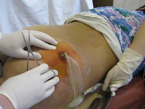Абсцесс после укола в ягодицу, лечение постинъекционного инфильтрата
