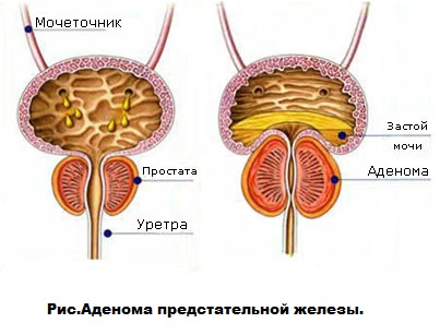 Аденома предстательной железы — симптомы, стадии, диагностика и лечение