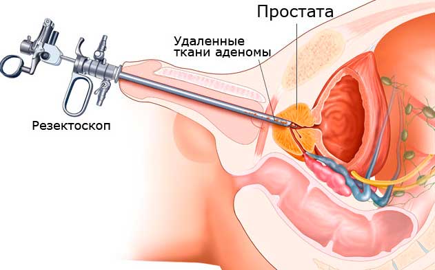 Аденома предстательной железы — симптомы, стадии, диагностика и лечение