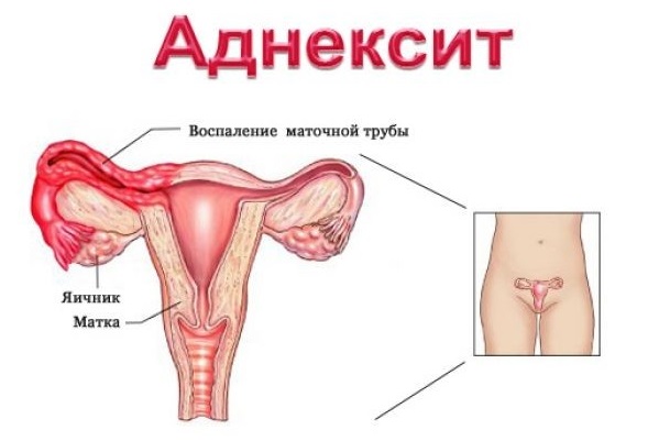 Аднексит: признаки и лечение воспаления придатков у женщины при менопаузе