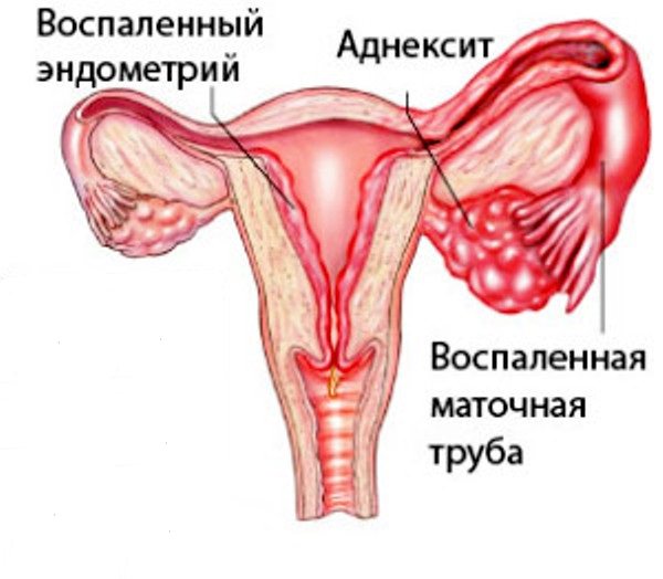 Аднексит: симптомы, причины, диагностика, лечение, последствия