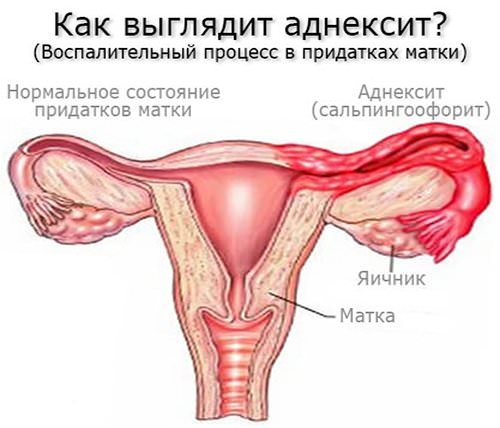 Аднексит: симптомы, причины, диагностика, лечение, последствия