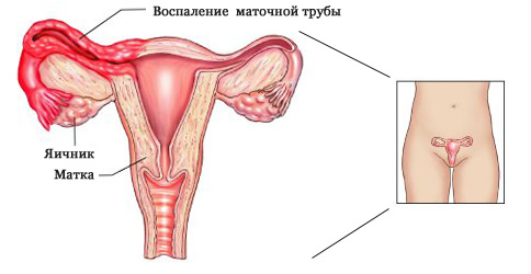 Аднексит: симптомы, причины, диагностика, лечение, последствия