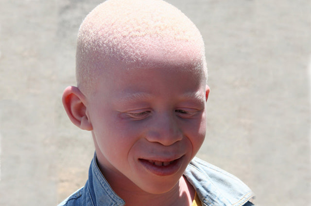 Альбинос: кто такой, 3 типа альбинизма, способы лечения, советы, видео