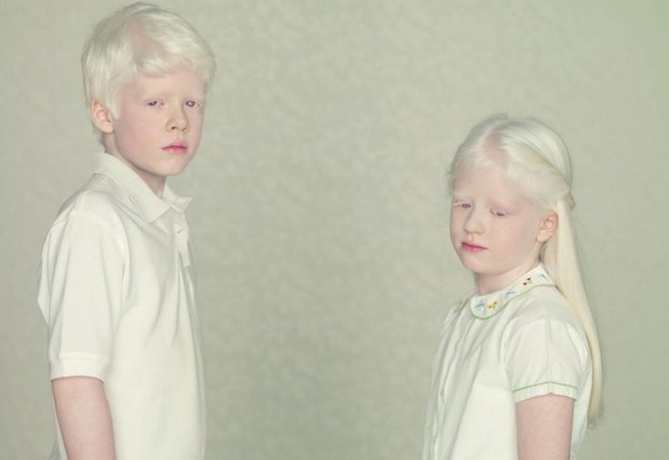 Альбинос: кто такой, 3 типа альбинизма, способы лечения, советы, видео