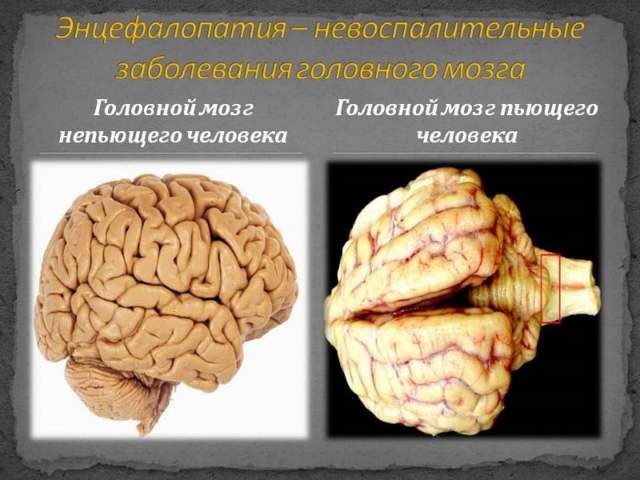 Алкогольная энцефалопатия головного мозга токсическая, последствия и прогноз