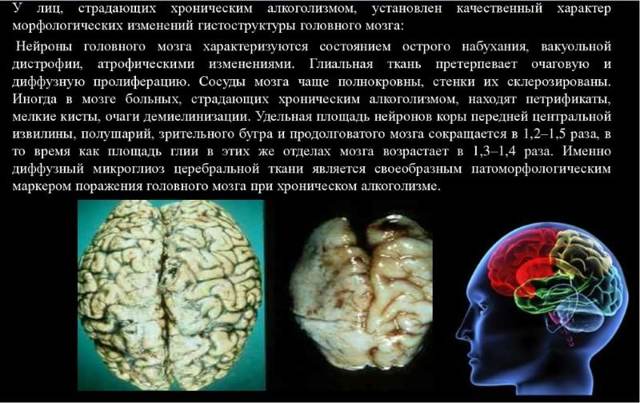 Алкогольная энцефалопатия головного мозга токсическая, последствия и прогноз