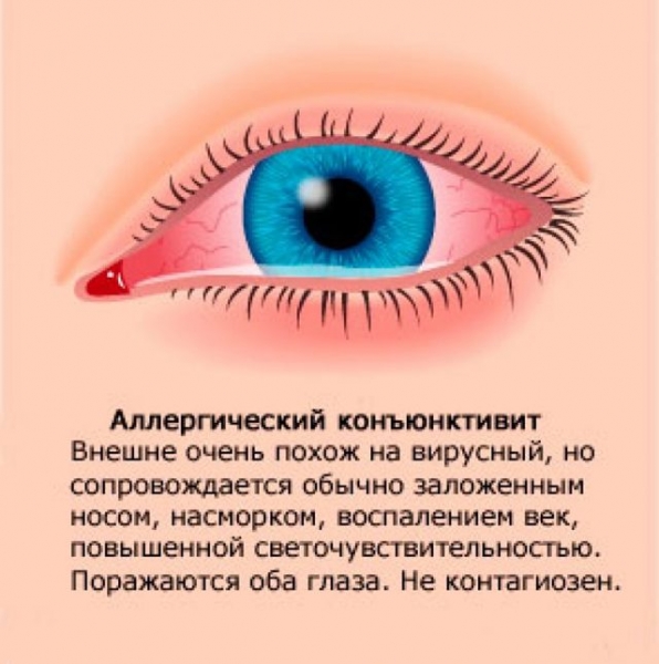 Аллергический конъюнктивит: симптомы, причины, виды, методы лечения аллергического конъюнктивита