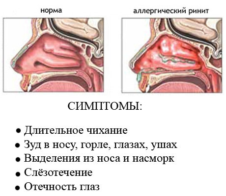 Аллергический ринит: симптомы и лечение у взрослых