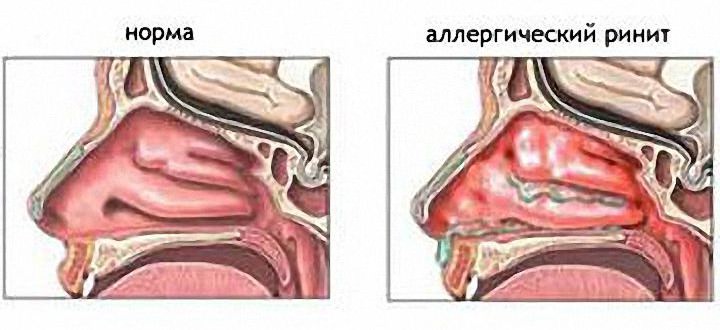 Аллергический ринит: симптомы и лечение у взрослых