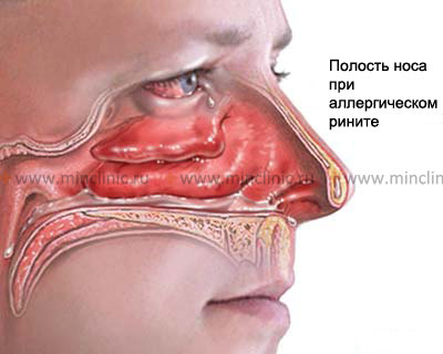 Аллергический ринит: симптомы и лечение у взрослых