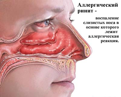 Аллергический ринит у детей: симптомы, причины, лечение и профилактика