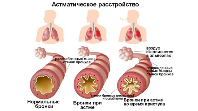 Аллергия на пыль, клеща домашней пыли: симптомы, лечение, особенности у детей