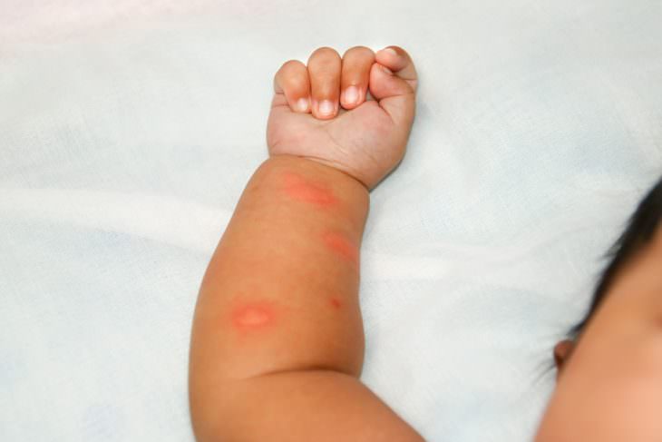 Аллергия на укусы насекомых — фото, симптомы, что делать, лечение у детей и взрослых