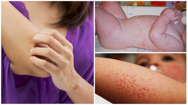 Аллергия на укусы насекомых — фото, симптомы, что делать, лечение у детей и взрослых