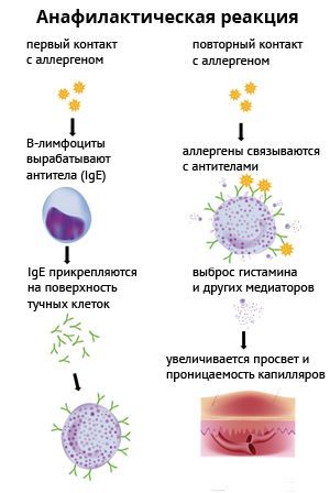 Анафилактический шок: симптомы, причины развития, степени и формы, неотложная помощь при анафилактическом шоке