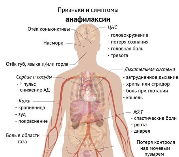 Анафилактический шок: симптомы, причины развития, степени и формы, неотложная помощь при анафилактическом шоке