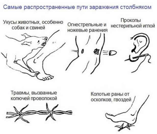 Анализ на столбняк на антитела, как делают и где сдать