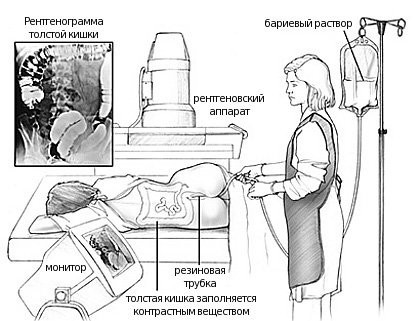 Анальные трещины: симптомы, причины появления,  методы лечения трещин в заднем проходе.