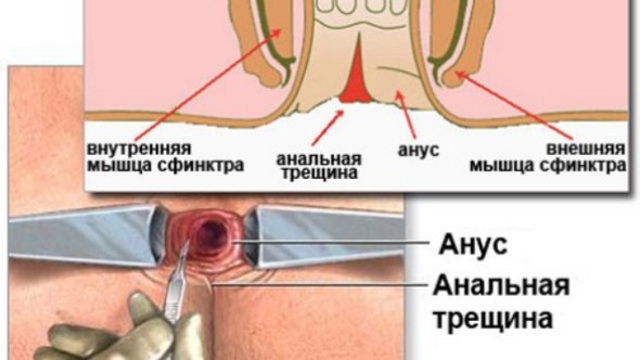 Анальные трещины: симптомы, причины появления,  методы лечения трещин в заднем проходе.