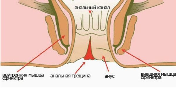 Анальные трещины: симптомы, причины появления,  методы лечения трещин в заднем проходе.
