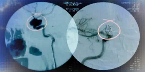 Аневризма сосудов головного мозга: симптомы, лечение, операции при аневризме