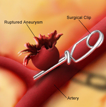 Аневризма сосудов головного мозга: симптомы, лечение, операции при аневризме
