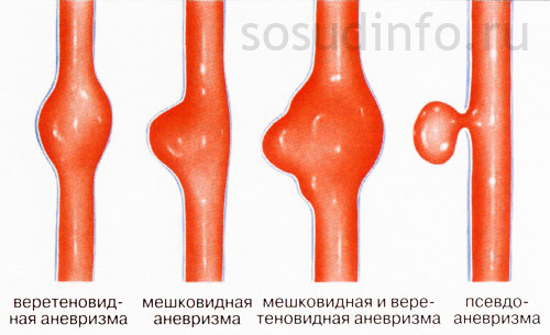 Аневризма сосудов головного мозга: симптомы, лечение, операции при аневризме