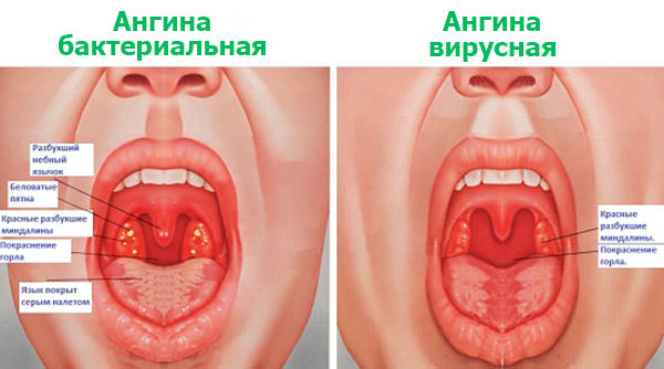 Ангина – симптомы и лечение народными средствами