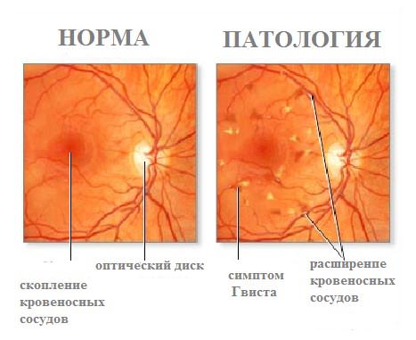 Ангиопатия сетчатки глаза — что это такое, причины, симптомы, лечение