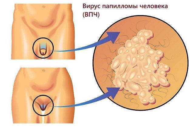 Аногенитальный кондиломатоз: причины, симптомы, лечение, профилактика