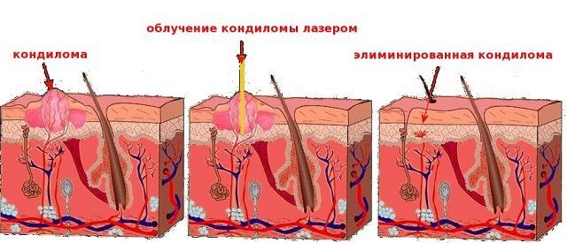 Аногенитальный кондиломатоз: причины, симптомы, лечение, профилактика