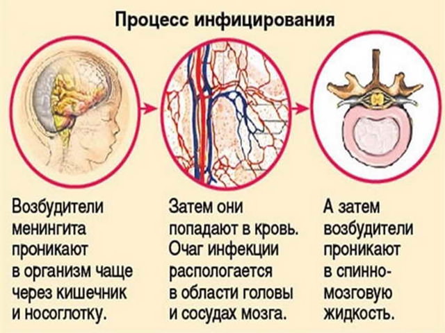 Антибиотики при менингите для лечения детей и взрослых