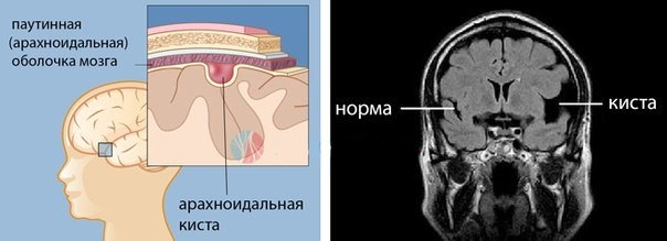 Арахноидальная киста головного мозга, виды и причины, симптомы и лечение