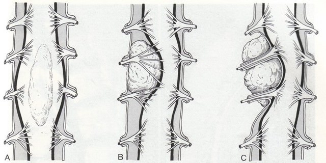 Арахноидальная киста крестцового отдела позвоночника, лечение