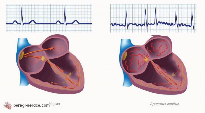 Аритмия сердца: причины, симптомы, лечение, виды аритмии, первая помощь