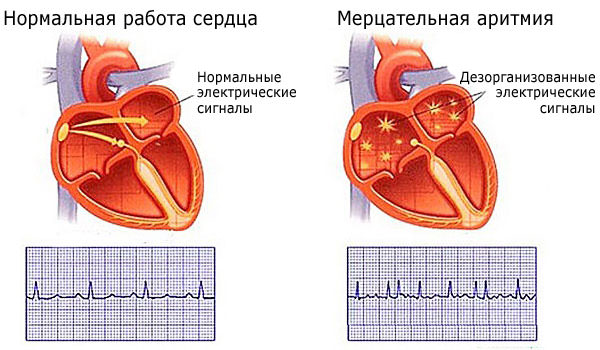 Аритмия сердца: причины, симптомы, лечение, виды аритмии, первая помощь