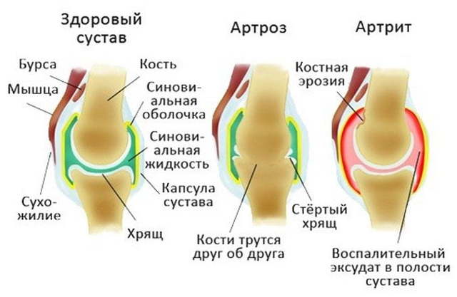 Артрит и артроз: в чем разница, лечение артрита и артроза, симптомы