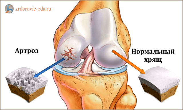Артрит и артроз: в чем разница, лечение артрита и артроза, симптомы