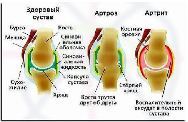 Артрит и артроз: в чем разница, лечение артрита и артроза, симптомы